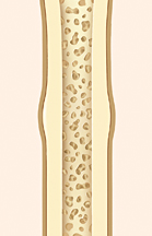 Cross section of bone showing healed fracture.