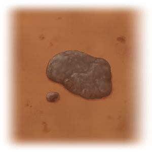 Seborrheic keratosis on dark skin.