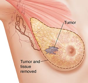 Three-quarter view of female underarm area showing breast anatomy ghosted in. Outline around tissue for simple mastectomy.