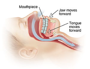 Side view of head with arrow showing path of air through nasal passages into trachea. Arrows show mouthpiece moving lower jaw forward.